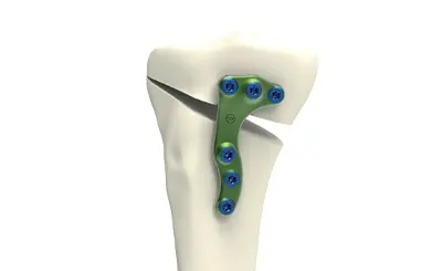 HTO opening medial plate