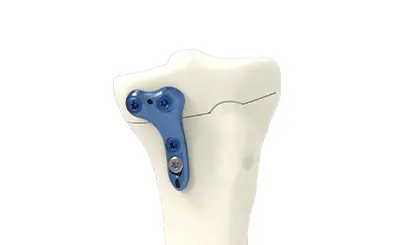 HTO closing medial plate