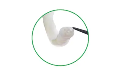 Avance Nerve Graft