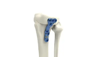 HTO closing lateral plate