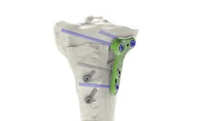 HTO Anterior Slope Change