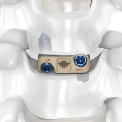 ArcadiusXP C stand-alone anterior cervical cage, view 4