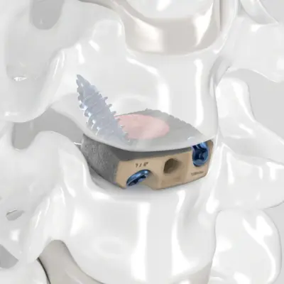 ArcadiusXP C stand-alone anterior cervical cage, view 5