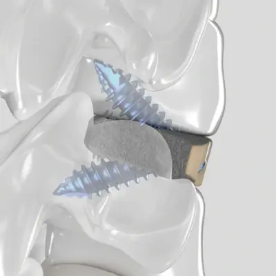 ArcadiusXP C stand-alone anterior cervical cage, view 7