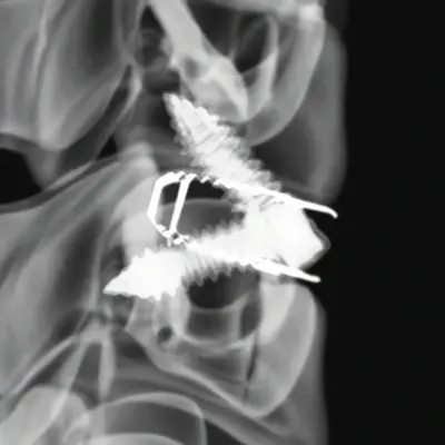ArcadiusXP C stand-alone anterior cervical cage, view 8