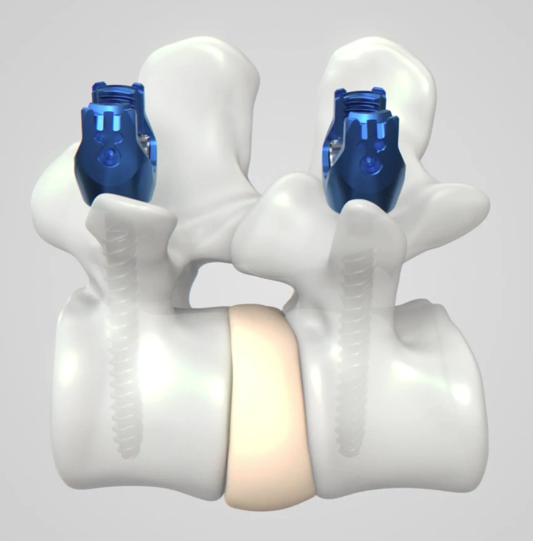 Ennovate® TLSP PolyLock®
