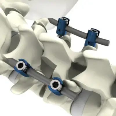 S4 Spinal System posterior fixation, view 3