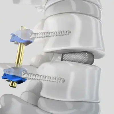 PROSPACE 3D Oblique transforaminal lumbar interbody device