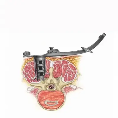 Spine Classics MLD System lumbar retractor, view 2