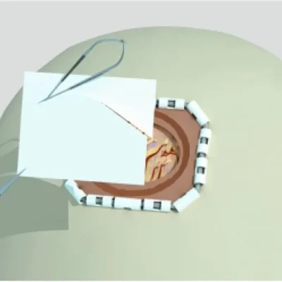 ReDura biomimetic dural repair patch, view 5