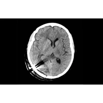 Cranial Loop Flap Fixation