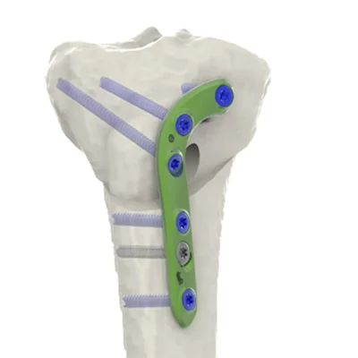 HTO Anterior Slope Change