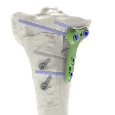 HTO Anterior Slope Change