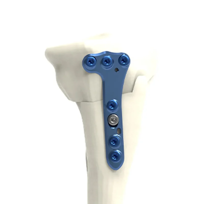 HTO closing medial plate