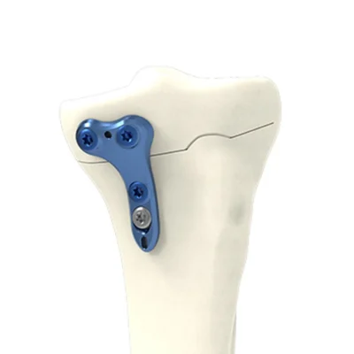 HTO closing medial plate