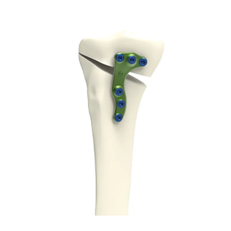 HTO opening medial plate