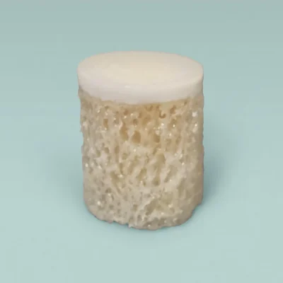 Osteochondral Allograft - precut fresh OCA cores