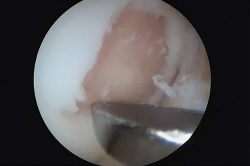 Arthroscopic view of a knee cartilage defect being prepared for AMIC